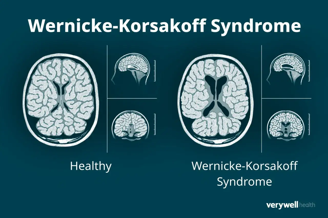 Gehirnscans zeigen Unterschiede: gesunder Gehirnaufbau vs. atrophierte Bereiche bei Korsakow-Syndrom.